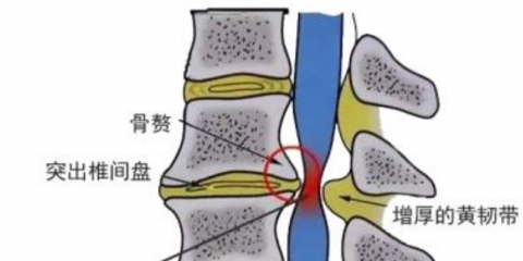 不是所有的頸椎病人都能按摩？