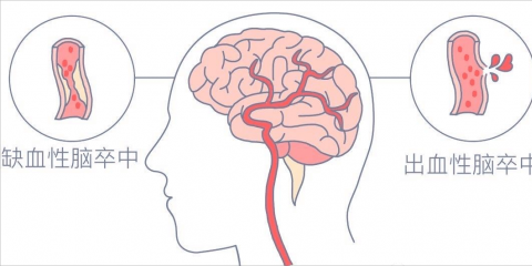 牢記兩大口訣，盡早識(shí)別急性腦血管疾病——“腦卒中”
